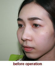 plastic_surgery_augmentation_rhinoplasty